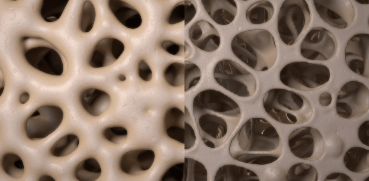 a side-by-side rendering of bones with good and poor density