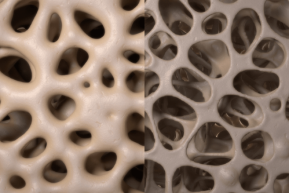 a side-by-side rendering of bones with good and poor density